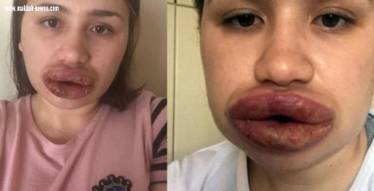 بالصور.. طبيب مزيف يشوه شفتي فتاة تركية